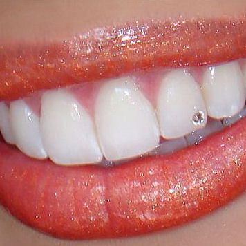Zubní šperky